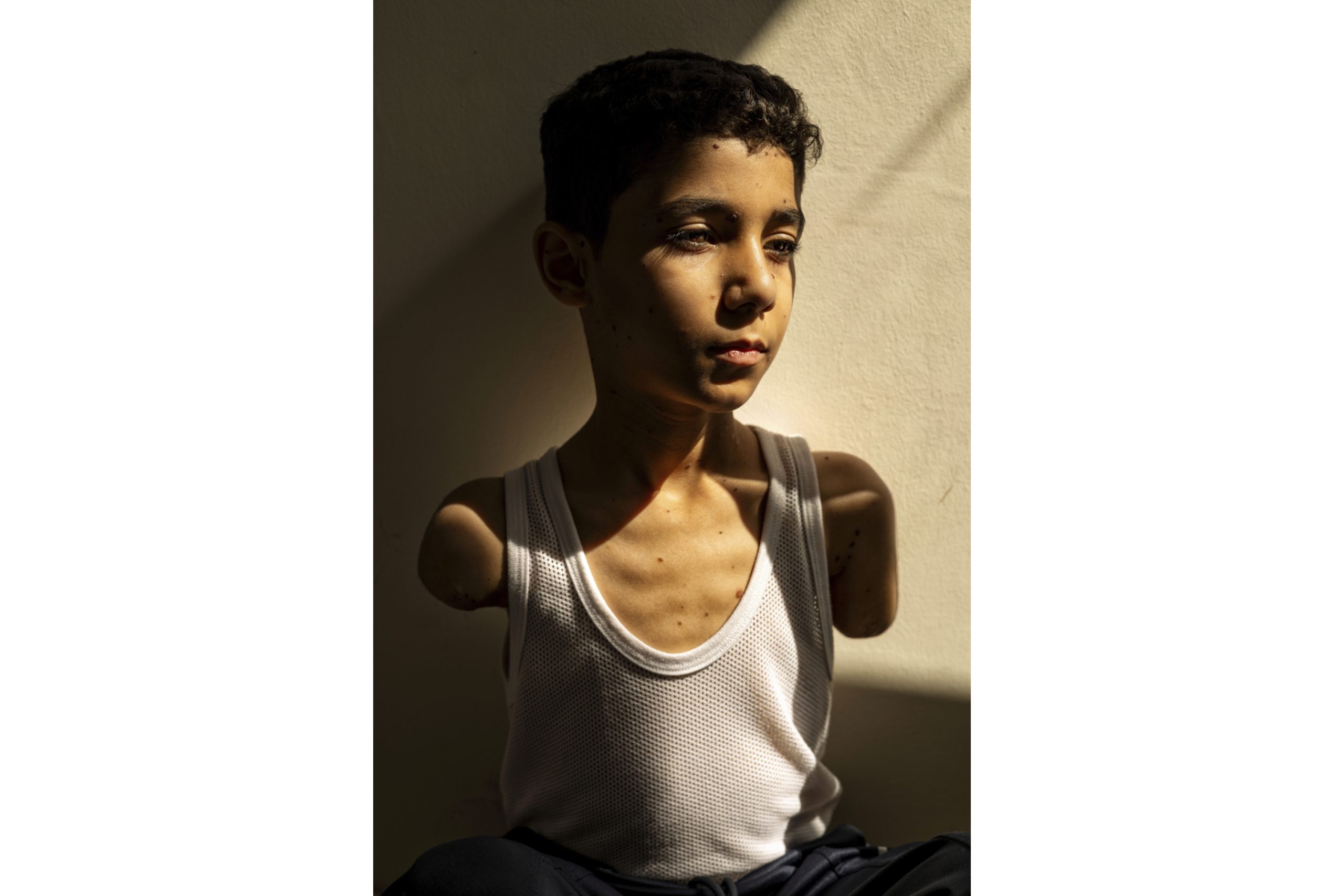 Portrait of Palestinian boy who lost both arms is World Press Photo of the year for 2025